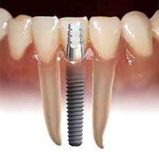 ¿Cuales son los análisis iniciales para un paciente que necesita implantes? 1BCDDF 1 ¿Cuales son los análisis iniciales para un paciente que necesita implantes?