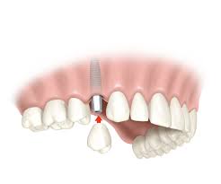 Periodoncia corona sobre implante dental Periodoncia