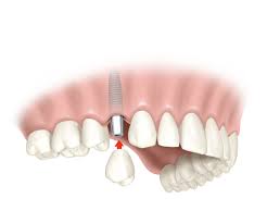 corona sobre implante dental Periodoncia