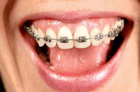Medidas de higiene en pacientes con brackets 562960 Medidas de higiene en pacientes con brackets