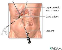 Gallbladder removal - series
