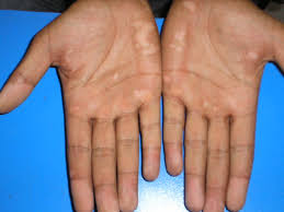 Before vitiligo treatment