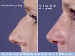 rhinoplasty photos