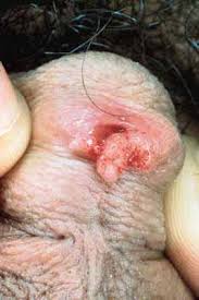 Transmitted Diseases