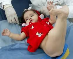 عروس البحر(صور) Doctors-begin-to-separate-mermaid-babys-legs