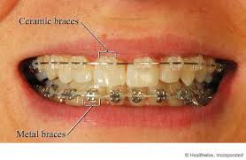 lingual braces, retainer