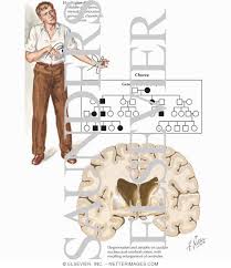 Huntingtons Disease persists