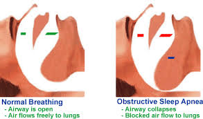all sleep apnea cases.