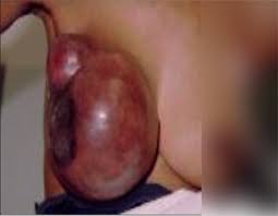 BUILDING BREAST CANCER