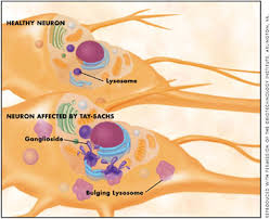 In Tay-Sachs disease,