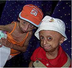 The effects of Progeria.