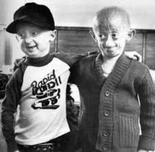 Children with Progeria are