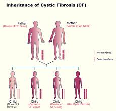 cystic fibrosis.
