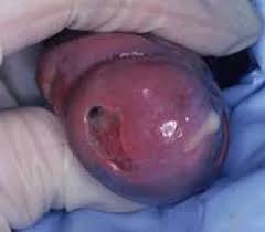 Of Gonorrhea - QwickStep