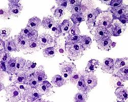 blood cancer cells.