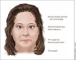 Prader-Willi syndrome.