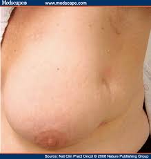 results after lumpectomy