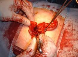 an emergency appendectomy.