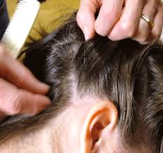 Head Lice Pictures Head Lice Pictures