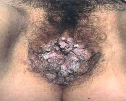 Papilloma Virus (HPV) | HPV