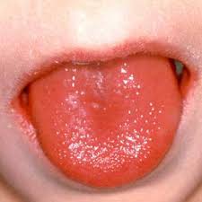 of scarlet fever,