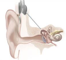Cochlear implant \x26middot; Hearing and