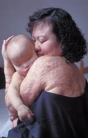 Heres the napalm girl,
