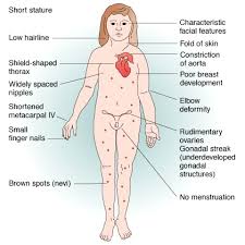 Symptoms Of Turners Syndrome