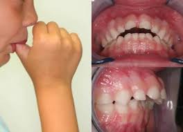 habitos1 Hábitos en la ortodoncia . . . cuida tu boca