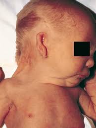 What is Turner syndrome?