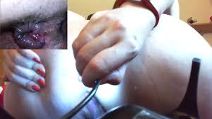 Anal endoscope porn videos jpg x Endoscope anal