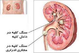 سنگ کلیه و درمان آن