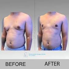 tiny puff nipples|Causes and treatments for puffy nipples in men, explained by Dr. Steven  Teitelbaum - YouTube