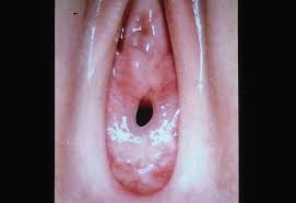 hymen child|Physical Examination in Child Sexual Abuse (10.10.2014)