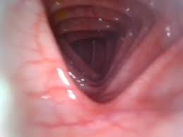 Endoscope anal jpg x Endoscope anal