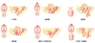 子宮脱|骨盤臓器脱センター – 厚木市立病院