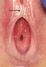  child labia hymen|Child Abuse: Normal Genitalia of Girls