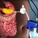 FDA Approves Weight Loss Stomach Pump AspireAssist to Combat Obesity 