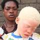 Albino people are being hunted for their body parts 