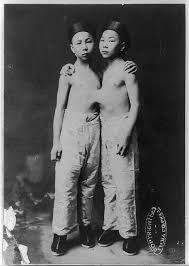 Conjoined twins jpg x Conjoined twins