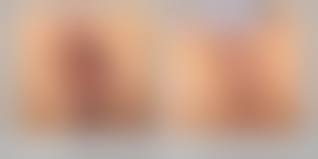 pussy before and after|Pregnancy Health Center - Episiotomy