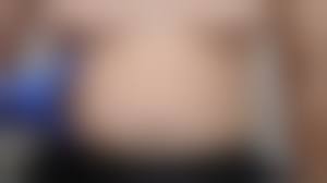 tiny puff nipples|Grade 1 Puffy Nipples- Will gland removal alone be enough to sort it?Been  quoted 4k by Dr Nurein. : r/gynecomastia