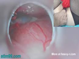 Endoscope anal jpg x Endoscope anal