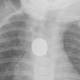 Button battery dangers prompt calls for new safety measures 