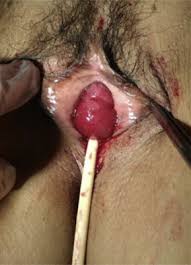 Pregnant finger fucking deep cervix prolapse jpg x Uterine prolapse