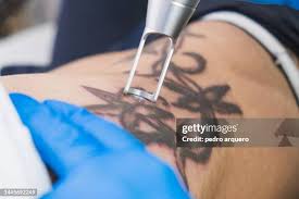 remove tattoo stock|520+ Laser Tattoo Removal Stock Photos, Pictures & Royalty-Free Images -  iStock | Laser hair removal, Laser treatment