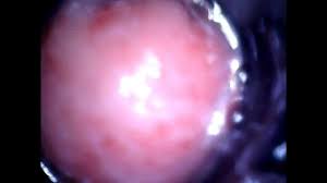 Endoscope anal jpg x Endoscope anal