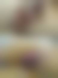 Отрезание пениса|Как делают обрезание крайней плоти | Меньщиков К.А.