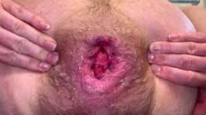 Vaginal prolapse porn videos faphouse jpg x Vaginal prolapse