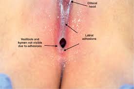 child hymen |Imperforate Hymen | Children's Hospital Colorado